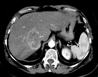 Ct Cholangiocarcinoma