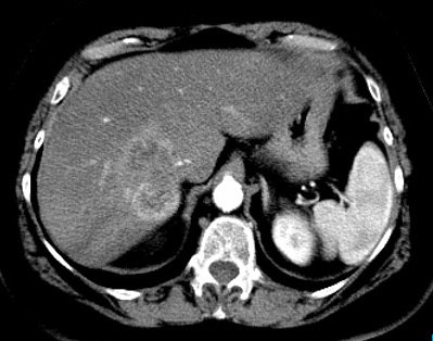 Ct Cholangiocarcinoma