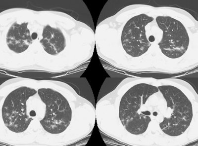 Ct Lung Small