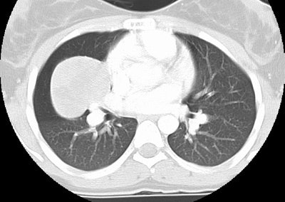 Ct Lung Windows Small