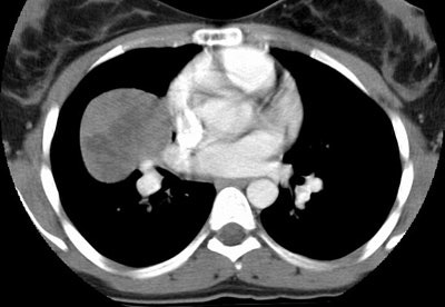 Ct Post Contrast Small