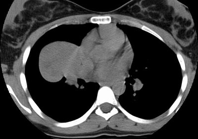 Ct Pre Contrast Small