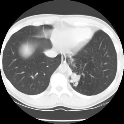 Ct Lung1 Small