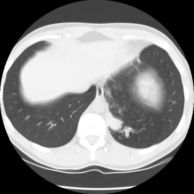 Ct Lung2 Small