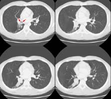 Ct Lung Small