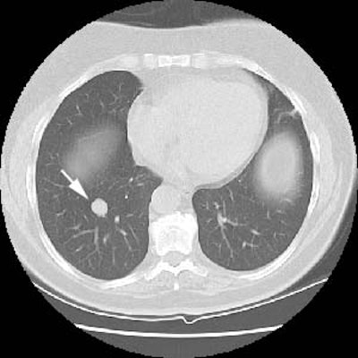Ct Lung