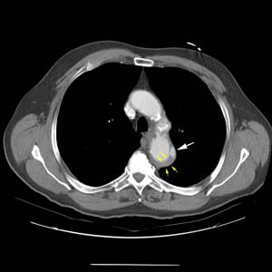 Ct Ulcer Small