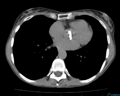 /ScottWilliamsMD2/CHEST/Pleura/Askins/Images/Case1/ct.jpg (131164 bytes)