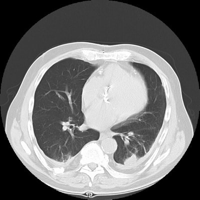Ct1 Lung Small