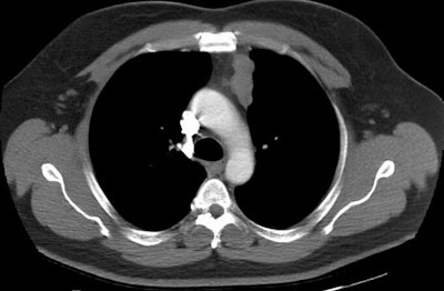 /ScottWilliamsMD2/CHEST/Mediastinum/Thymus/Images/Invasive%20thymoma1/ct1s.jpg (30498 bytes)