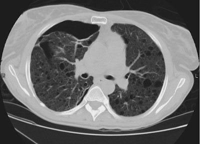 Ct2