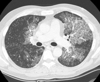 /ScottWilliamsMD2/CHEST/Autoimmune/Proteinosis/Images/Case2/ct2_sm.jpg (28831 bytes)