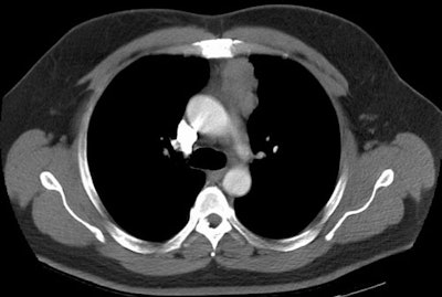 /ScottWilliamsMD2/CHEST/Mediastinum/Thymus/Images/Invasive%20thymoma1/ct2s.jpg (30414 bytes)