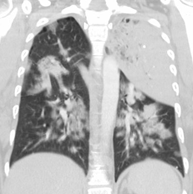 Ct Legionella