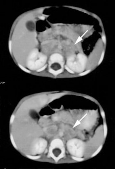 CT_Neuroblastoma2.jpg (18029 bytes)