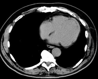 Ct Apical Infarct