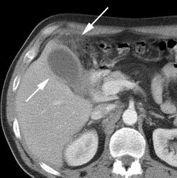 Ct Cholecystitis