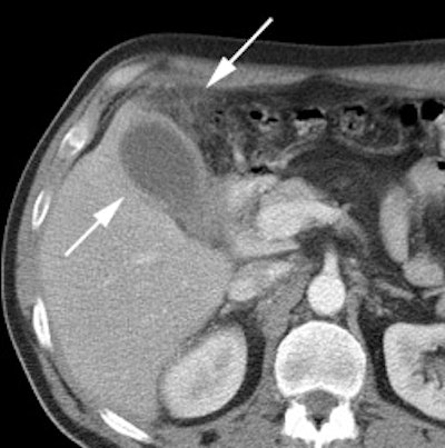 Ct Cholecystitis