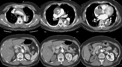 /ScottWilliamsMD2/CHEST/Vascular/Dissection/Images/TypeA/Case3/ct_con.jpg (102210 bytes)