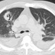 Ct Invasive Asperigillosis