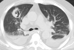 Ct Invasive Asperigillosis