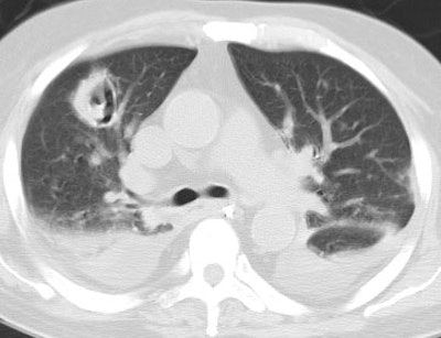 Ct Invasive Asperigillosis