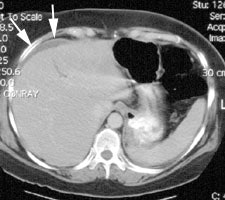 CT_leak1_sm.JPG (18609 bytes)