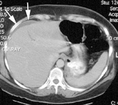 CT_leak1_sm.JPG (18609 bytes)