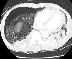 Ct Lung