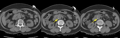 /ScottWilliamsMD2/CHEST/Vascular/Dissection/Images/TypeA/Case3/ct_non_con.jpg (50751 bytes)