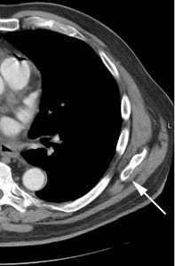 Ct Scapular Met