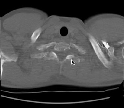 /ScottWilliamsMD2/CHEST/Mediastinum/Schwannoma/Images/Case1/ctbone.jpg (16366 bytes)