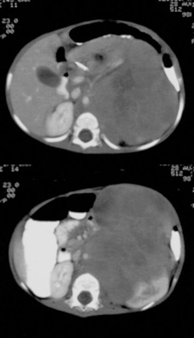 CTsm_Neuroblastoma1.JPG (24400 bytes)