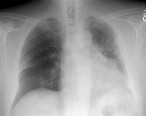 Cxr 6 After Xrt Incr Sob Small