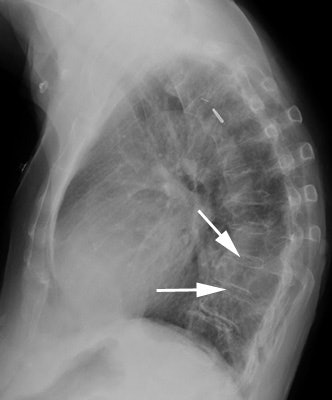 Cxr Lateral