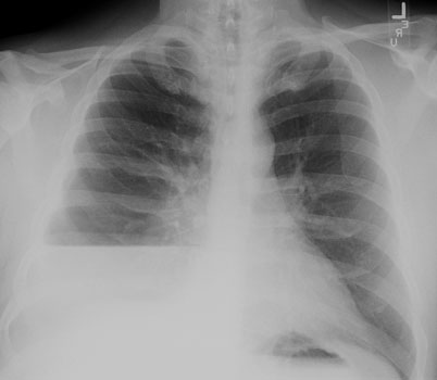 Cxr Pa