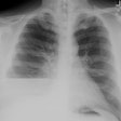 Cxr Pa