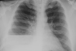 Cxr Pa