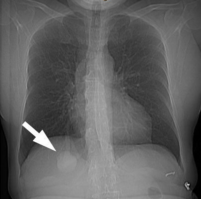 Cxr Rll Avm