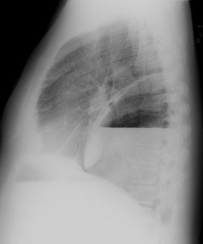Cxr Lateral