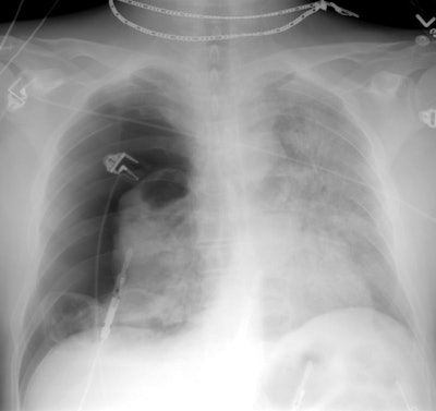CXR small.JPG (43207 bytes)