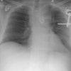 Cxr
