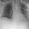 Cxr