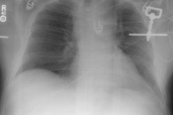 Cxr