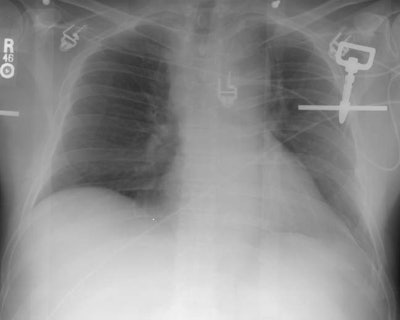 Cxr