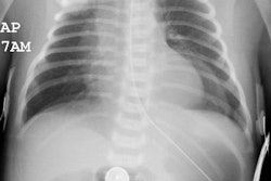 Cxr Ap