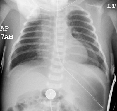Cxr Ap