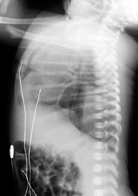 Cxr Lat