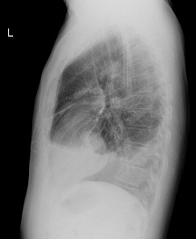 Cxr Lat