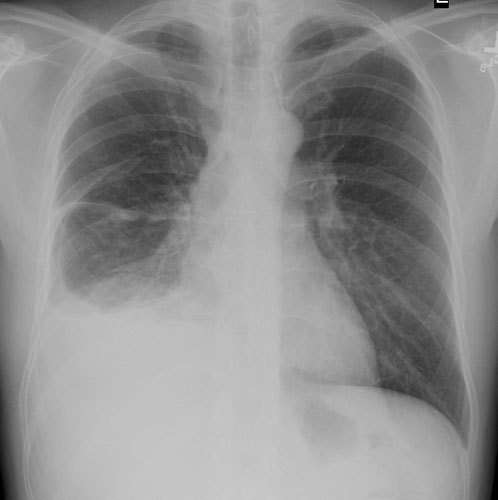 Cxr Pa